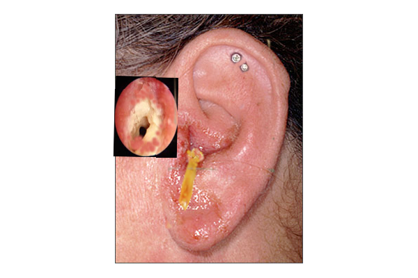 “otitis externa.gif” by S bhjimji MD is licensed under CC BY 4.0. Access for free at https://www.ncbi.nlm.nih.gov/books/NBK556055/ Photo showing ear infected with otitis externa, or swimmer's ear