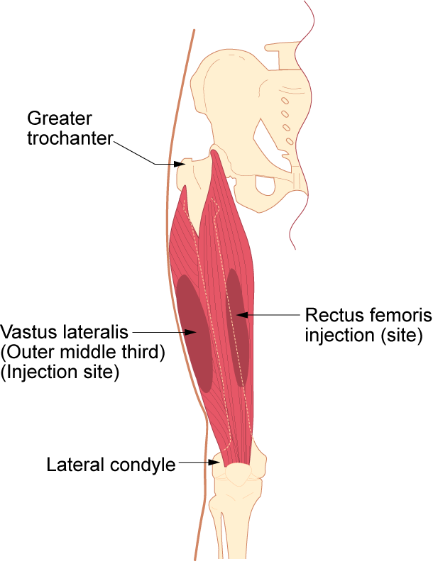 “Im-vastus-lateralis.png” by British Columbia Institute of Technology (BCIT) is licensed under CC BY 4.0. Access for free at https://opentextbc.ca/clinicalskills/chapter/6-7-intradermal-subcutaneous-and-intramuscular-injections/ Illustration showing vastus lateralis site, with labels