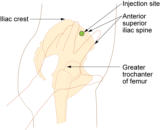 “Im-ventrogluteal-300x244.png” by British Columbia Institute of Technology (BCIT) is licensed under CC BY 4.0. Access for free at https://opentextbc.ca/clinicalskills/chapter/6-8-iv-push-medications-and-saline-lock-flush/ Illustration showing how to locate the ventrogluteal site