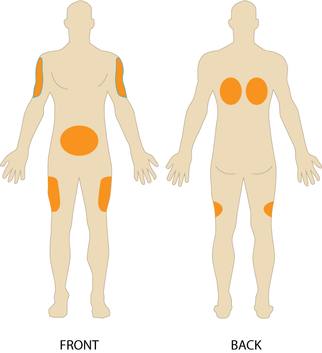 “Subcutaneous-injection-sites-274x300.png”by British Columbia Institute of Technology (BCIT) is licensed under CC BY 4.0. Access for free at https://opentextbc.ca/clinicalskills/chapter/6-7-intradermal-subcutaneous-and-intramuscular-injections/ Illustration showing subcutaneous injection sites