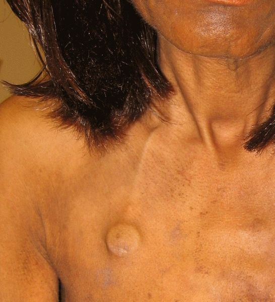 "Port-catheter.jpg" by Una Smith (talk) is licensed under CC0 Image showing an Implanted venous access device on a patient