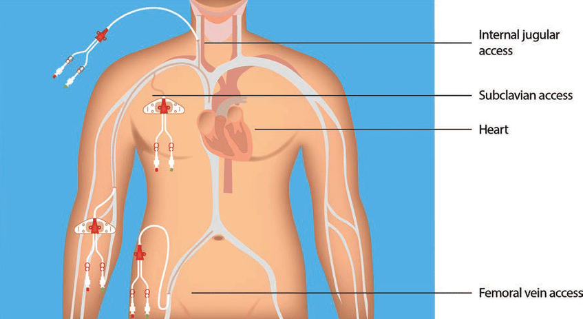 “Central-venous-access-sites.png” by unknown author is licensed under CC B-NC-ND. Access for free at https://www.researchgate.net/figure/Central-venous-access-sites_fig1_334584348 Illustration showing C V A D Insertion Sites with textual labels