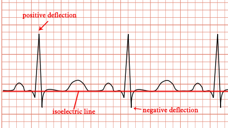 ”ECG deflection.gif” is derivative of Tachycardia_ECG_paper.svg by Madhero88 and licensed under CC BY-SA 3.0. Access for free at http://simple-cardio.blogspot.com/2012/12/ecg-ekg-paper.html Image showing the Isoelectric Line
