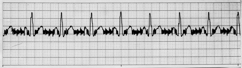 “Sinus Rhythm with Artifact” by Deanna Hoyord is licensed under CC BY 4.0 Image showing an artifact on an ECG strip