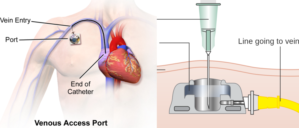"Diagram_showing_an_implantable_port_under_the_skin_CRUK_100.svg" by Cancer Research UK and "Venous_Access_Port_Catheter.png" by BruceBlaus are both licensed under CC BY-SA 4.0 Illustrations showing the under skin view of an implanted venous access device